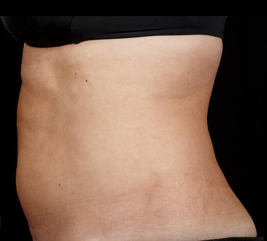 edmonton sculpsure