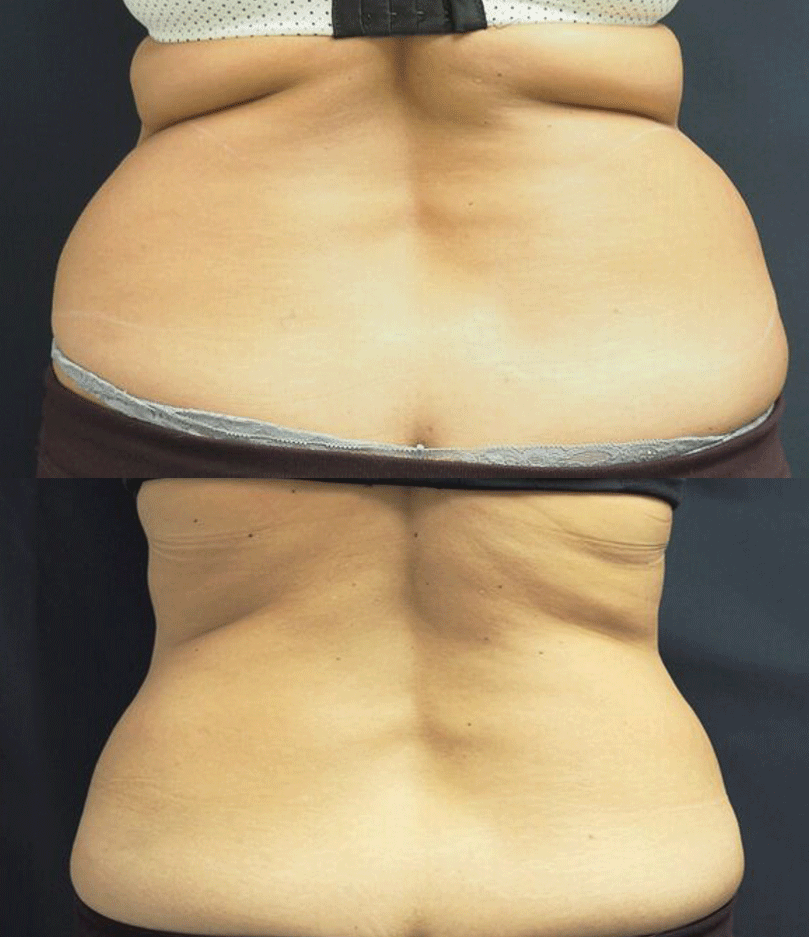 Best CoolSculpting Edmonton For Stubborn Fat Removal